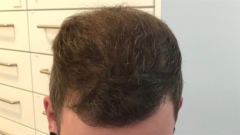 https://www.hairtransplantfue.org/asmed-hair-transplant-result/upload/Norwood6/5021-grafts-FUE/6months/AFTER1.jpg