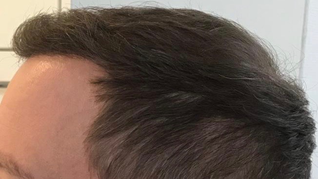 https://www.hairtransplantfue.org/asmed-hair-transplant-result/upload/Norwood6/5021-grafts-FUE/6months/AFTER2.jpg