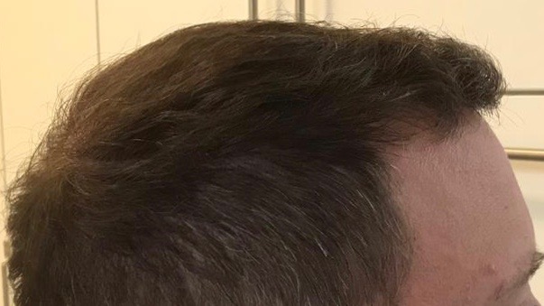 https://www.hairtransplantfue.org/asmed-hair-transplant-result/upload/Norwood6/5021-grafts-FUE/6months/AFTER3.jpg