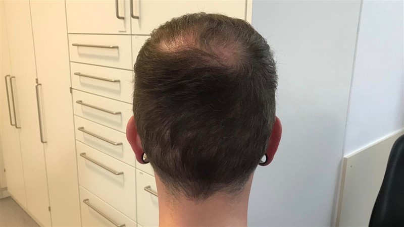 https://www.hairtransplantfue.org/asmed-hair-transplant-result/upload/Norwood6/5021-grafts-FUE/6months/AFTER4.jpg
