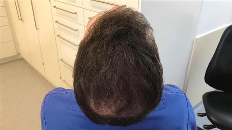 https://www.hairtransplantfue.org/asmed-hair-transplant-result/upload/Norwood6/5021-grafts-FUE/6months/AFTER5.jpg