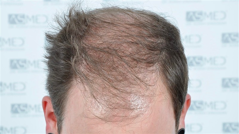 https://www.hairtransplantfue.org/asmed-hair-transplant-result/upload/Norwood6/5021-grafts-FUE/before/BEFORE1.jpg