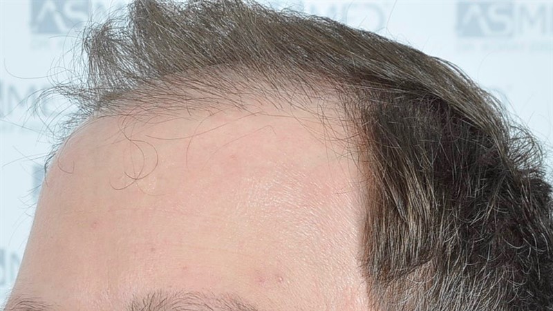 https://www.hairtransplantfue.org/asmed-hair-transplant-result/upload/Norwood6/5021-grafts-FUE/before/BEFORE2.jpg