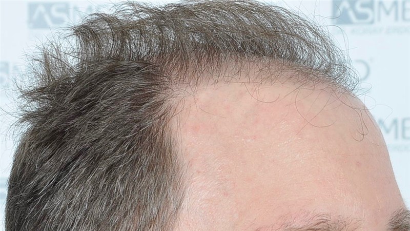 https://www.hairtransplantfue.org/asmed-hair-transplant-result/upload/Norwood6/5021-grafts-FUE/before/BEFORE3.jpg