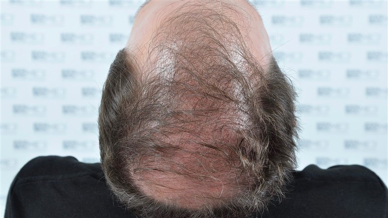 https://www.hairtransplantfue.org/asmed-hair-transplant-result/upload/Norwood6/5021-grafts-FUE/before/BEFORE4.jpg