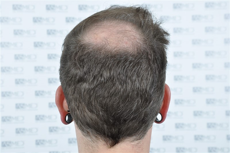 https://www.hairtransplantfue.org/asmed-hair-transplant-result/upload/Norwood6/5021-grafts-FUE/before/BEFORE5.jpg