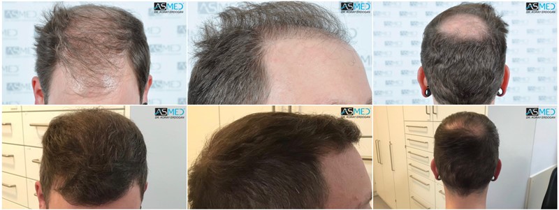 https://www.hairtransplantfue.org/asmed-hair-transplant-result/upload/Norwood6/5021-grafts-FUE/kolaj.jpg
