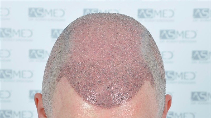 https://www.hairtransplantfue.org/asmed-hair-transplant-result/upload/Norwood6/5021-grafts-FUE/operation/OP1.jpg
