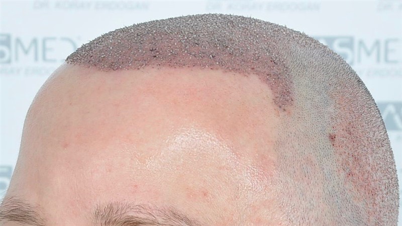 https://www.hairtransplantfue.org/asmed-hair-transplant-result/upload/Norwood6/5021-grafts-FUE/operation/OP2.jpg