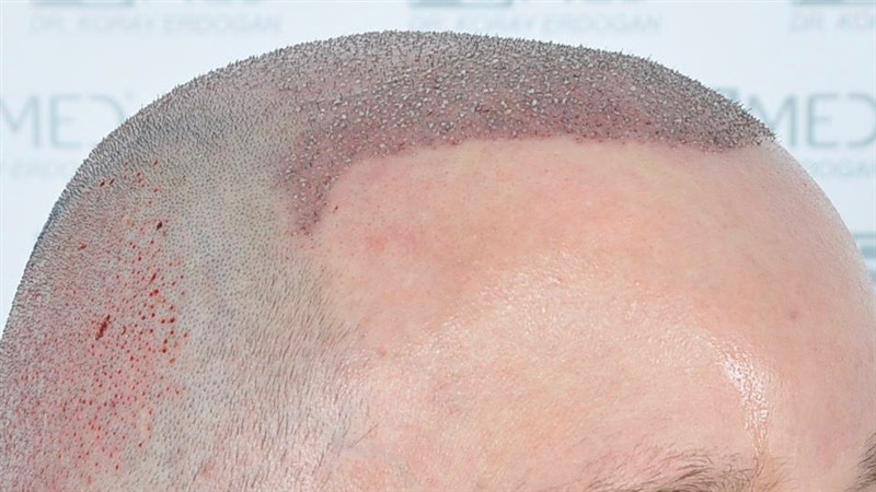https://www.hairtransplantfue.org/asmed-hair-transplant-result/upload/Norwood6/5021-grafts-FUE/operation/OP3.jpg