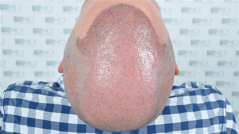https://www.hairtransplantfue.org/asmed-hair-transplant-result/upload/Norwood6/5021-grafts-FUE/operation/OP4.jpg