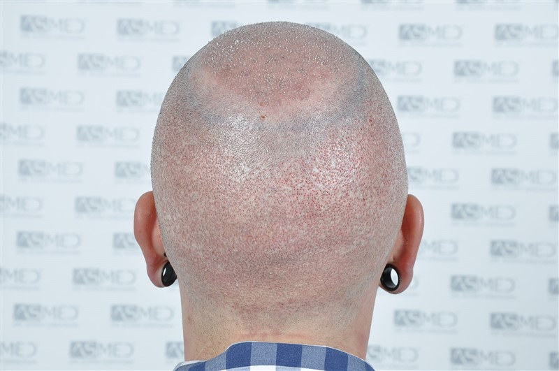 https://www.hairtransplantfue.org/asmed-hair-transplant-result/upload/Norwood6/5021-grafts-FUE/operation/OP5.jpg