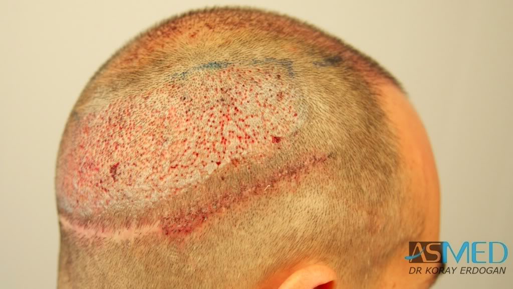 norwood4 2000-grafts-FUE-Repair 068f4425