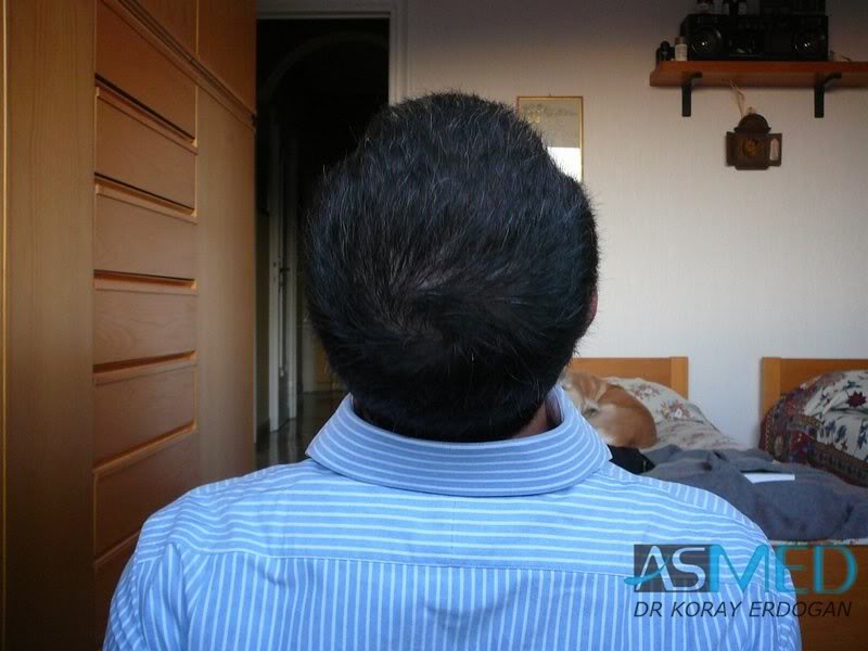 norwood4 2000-grafts-FUE-Repair 0a0d3994