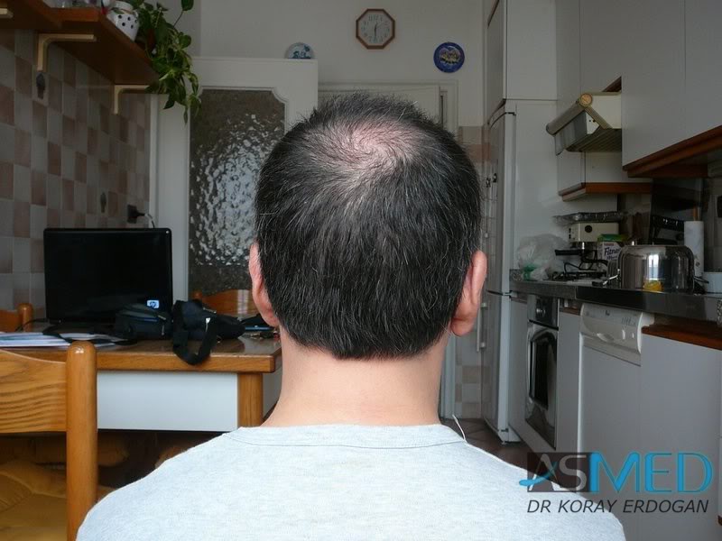 norwood4 2000-grafts-FUE-Repair 26657151