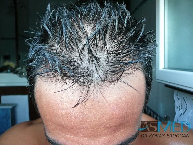 norwood4 2000-grafts-FUE-Repair 2843f320