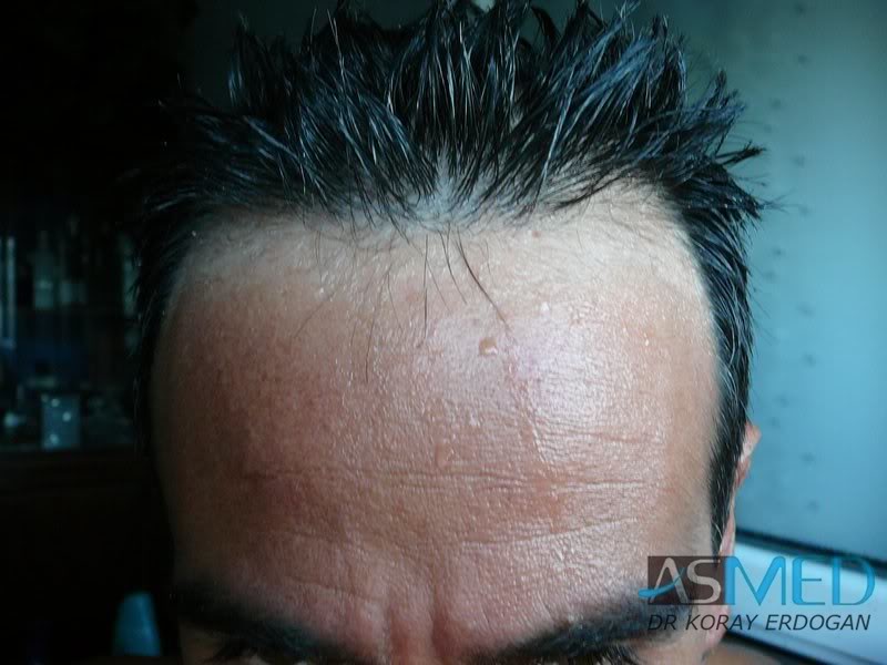 norwood4 2000-grafts-FUE-Repair 47fc2225