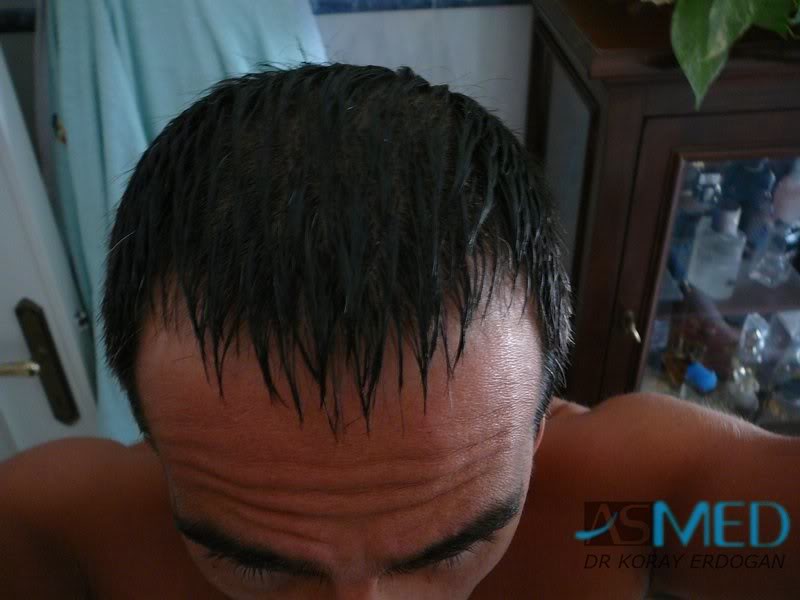 norwood4 2000-grafts-FUE-Repair 860751f2