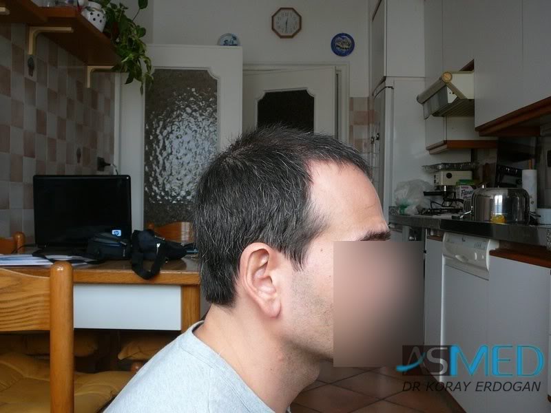 norwood4 2000-grafts-FUE-Repair 9778c985