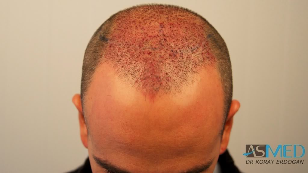 norwood4 2000-grafts-FUE-Repair a7e4c2b7