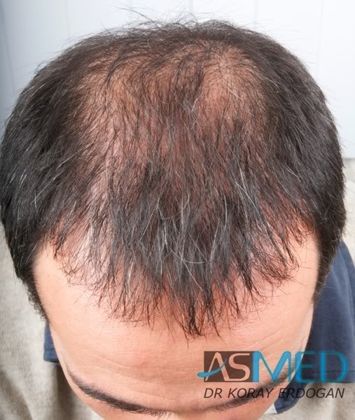 norwood4 2000-grafts-FUE-Repair b43bf2b0