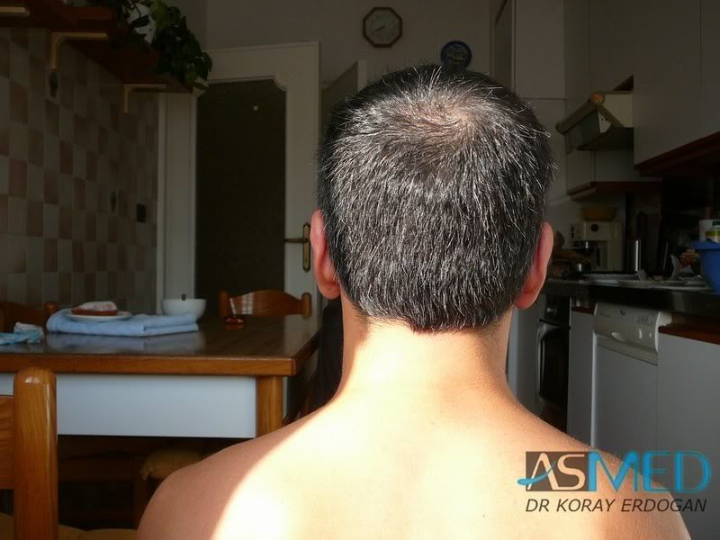 norwood4 2000-grafts-FUE-Repair c6e86aeb