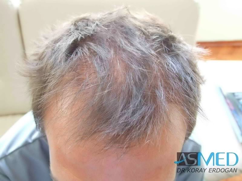 norwood4 2200-grafts-FUE-Repair 14aca8f0