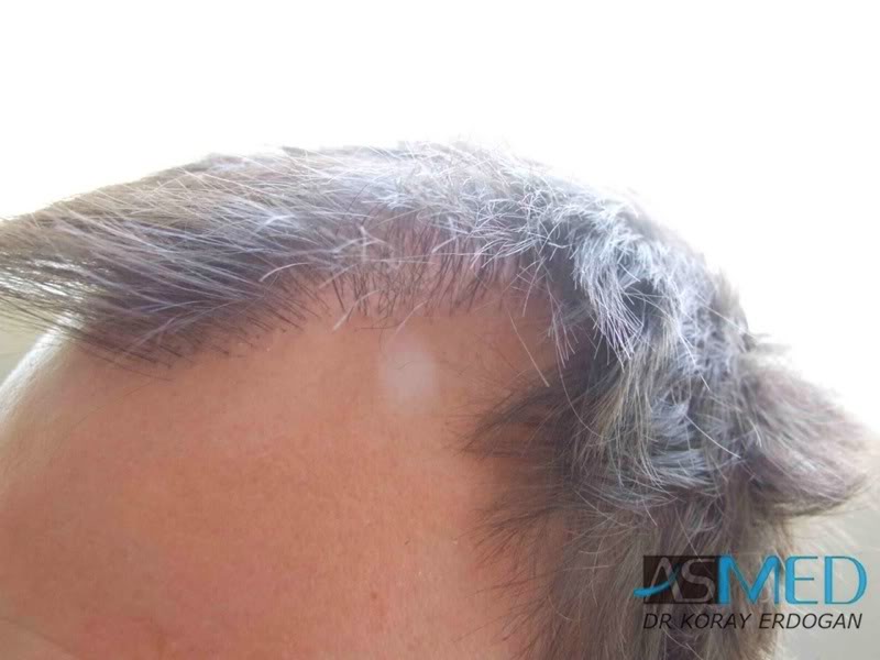 norwood4 2200-grafts-FUE-Repair 59089cd1