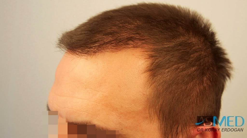 norwood4 2200-grafts-FUE-Repair 85caafd5