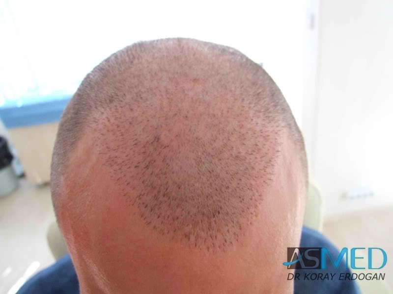 norwood4 2200-grafts-FUE-Repair ae60ad5e