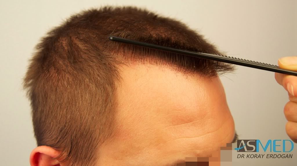 norwood4 2200-grafts-FUE-Repair ff378788