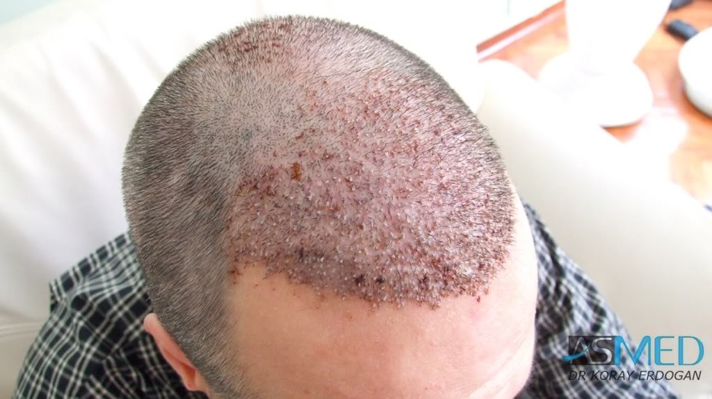 norwood4 2400-grafts-FUE-Repair 2116d4e8