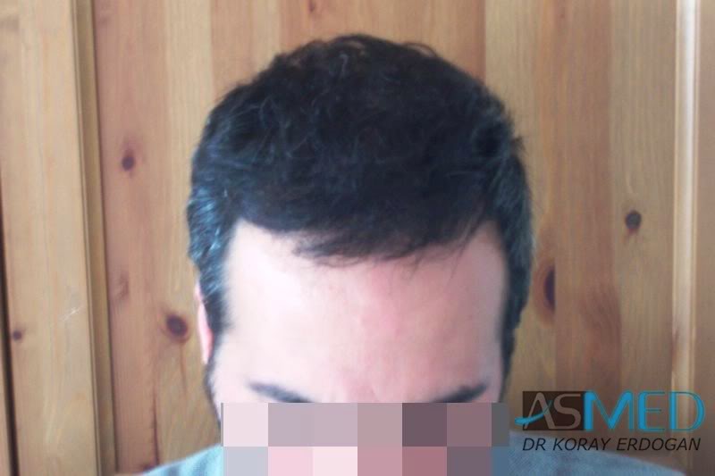 norwood4 2400-grafts-FUE-Repair 8981187c