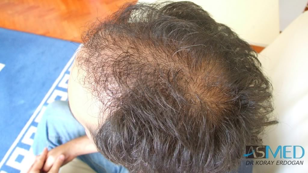 norwood4 2400-grafts-FUE-Repair 9009dbf0