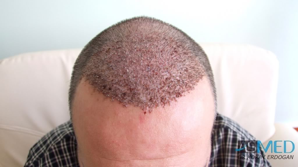 norwood4 2400-grafts-FUE-Repair 9c2b99e6