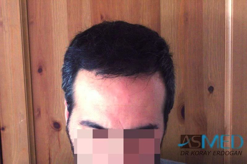 norwood4 2400-grafts-FUE-Repair ae3e081f
