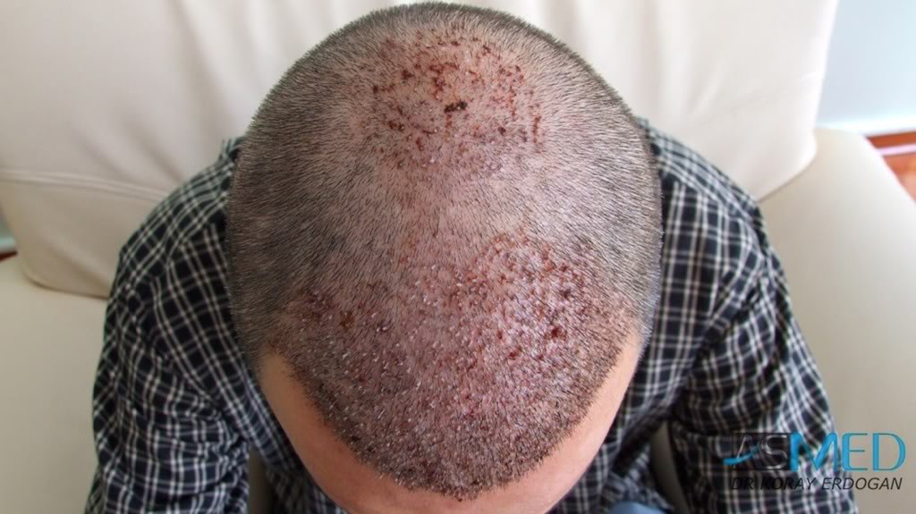 norwood4 2400-grafts-FUE-Repair bd21797e