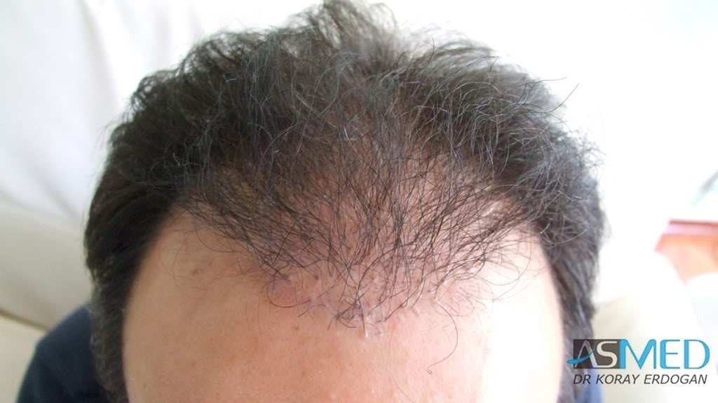 norwood4 2400-grafts-FUE-Repair ebf90c2f