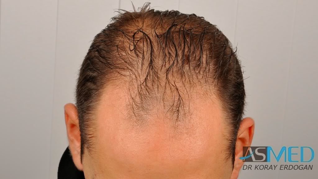 norwood4 2600-grafts-FUE-3 295951fc