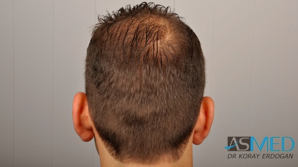 norwood4 2600-grafts-FUE-3 29dd8cbb