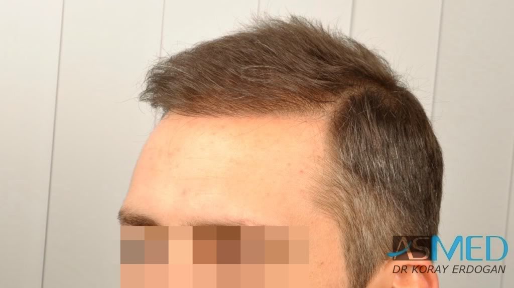 norwood4 2600-grafts-FUE-3 5a8ecd67