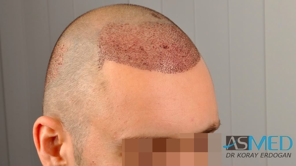 norwood4 2600-grafts-FUE-3 62451bda