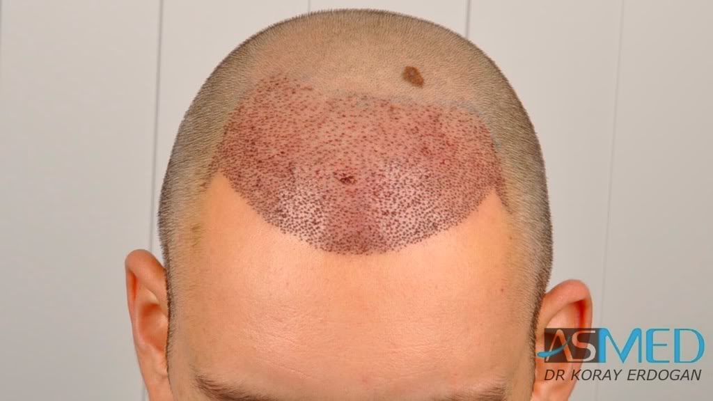 norwood4 2600-grafts-FUE-3 7f189084