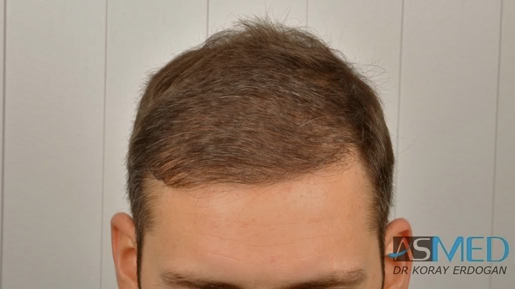 norwood4 2600-grafts-FUE-3 82ac787f