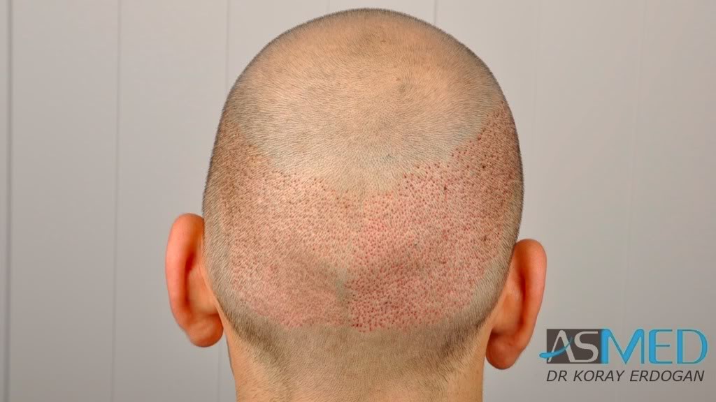 norwood4 2600-grafts-FUE-3 9736689a
