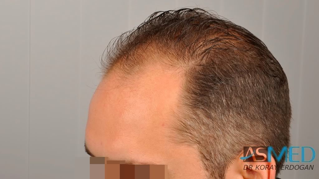 norwood4 2600-grafts-FUE-3 af5bed81