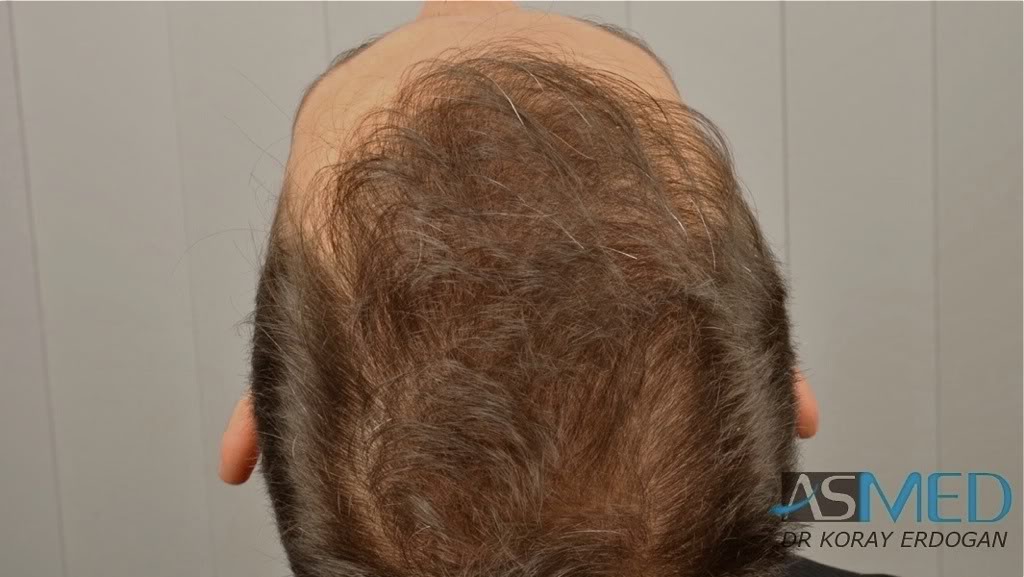 norwood4 2600-grafts-FUE-3 b0705a82