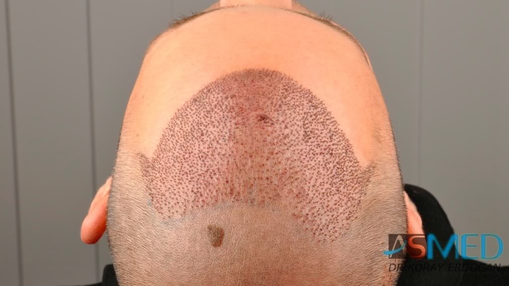 norwood4 2600-grafts-FUE-3 b34e35d1