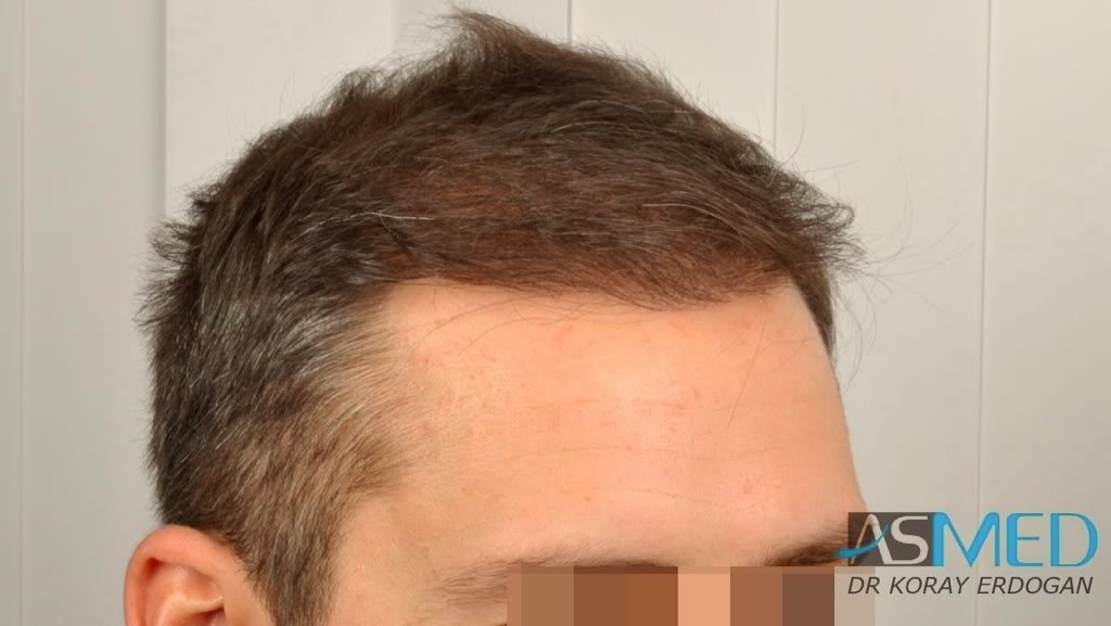 norwood4 2600-grafts-FUE-3 c4cba66d