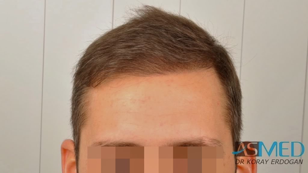 norwood4 2600-grafts-FUE-3 c6452c81